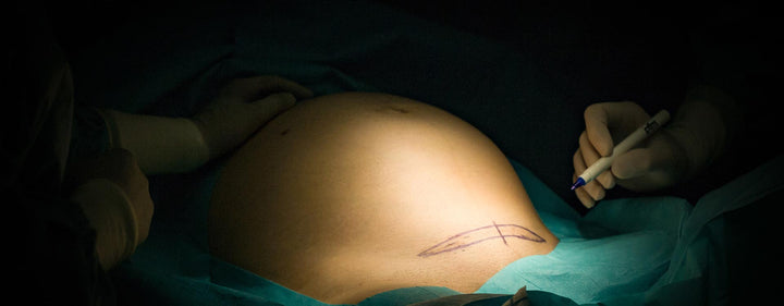 Kaiserschnitt – alles Wichtige über die Geburt per Sectio